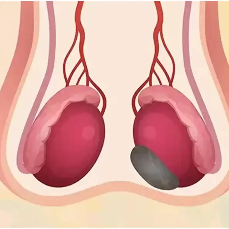 Don't-be late for epididymitis treatment