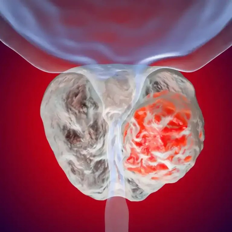 Early-detection of prostate-cancer