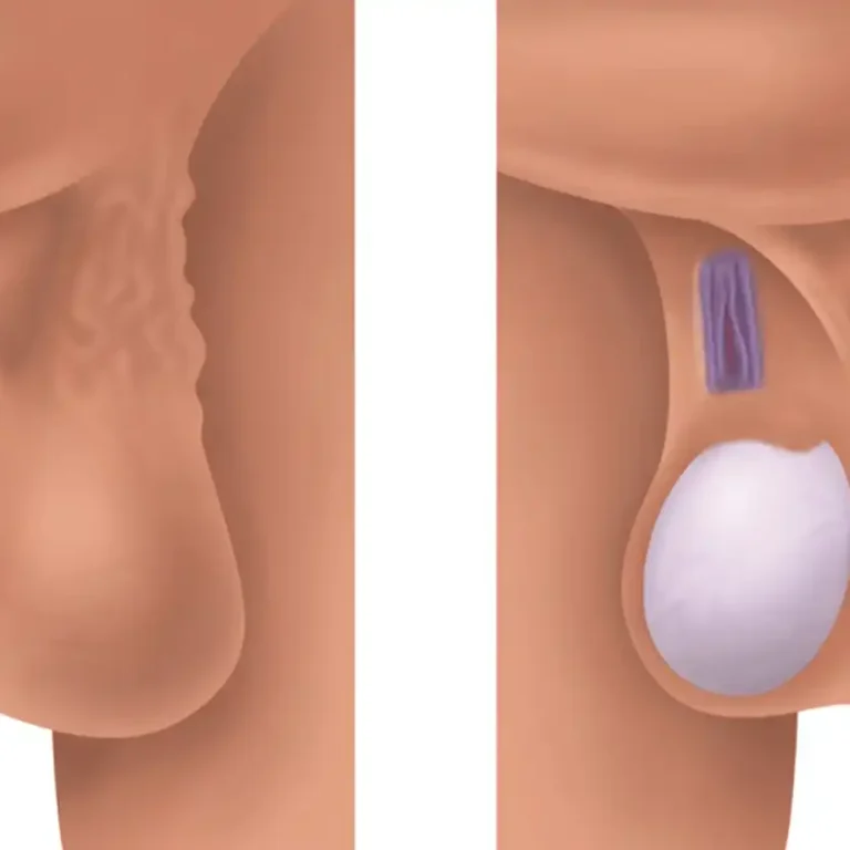 who-should-consider-varicocele-surgery
